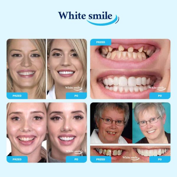 Realistycznie wyglądające implanty zębów: WhiteSmile 1+2 GRATIS